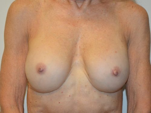 Breast Revision After Patient 1